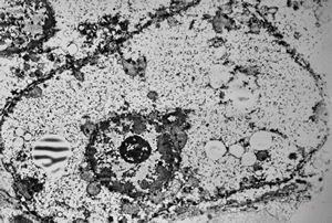 M,1y. | glycogenosis type I.(glycogen dissolved due to UA blockstaining) M,1y. | glycogenosis type I.(glycogen dissolved due to UA blockstaining)